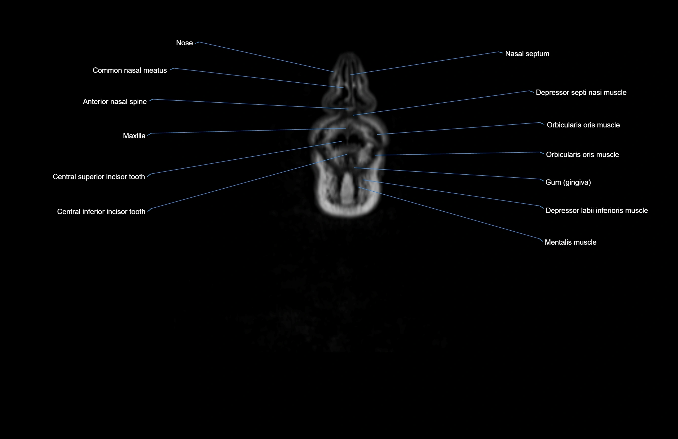 Neck coronal cross sectional MRI anatomy 3T MRI  image-img-00001-00078.webp